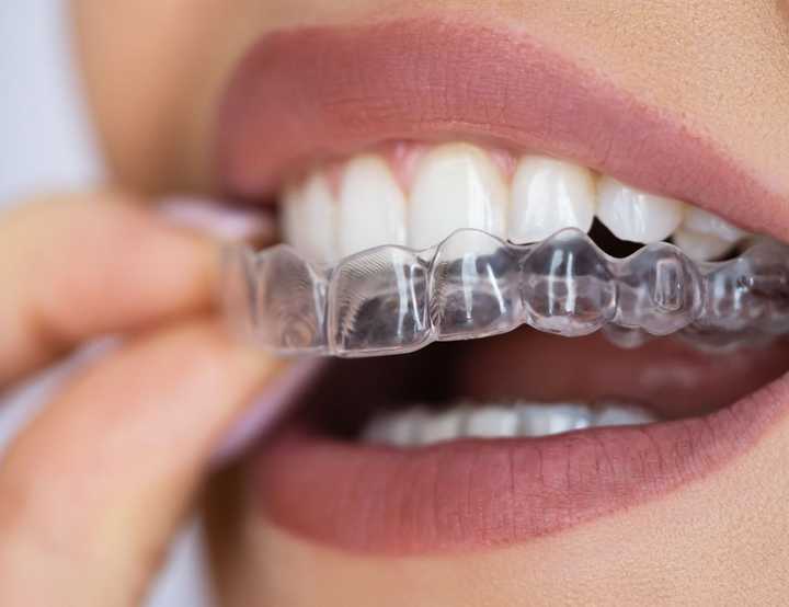 Retainers being placed onto teeth