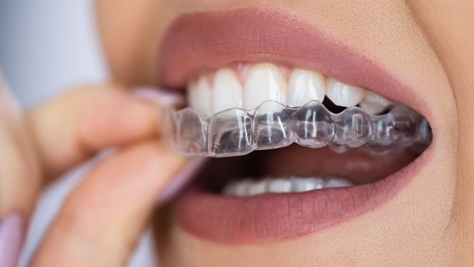 Retainers being placed onto teeth