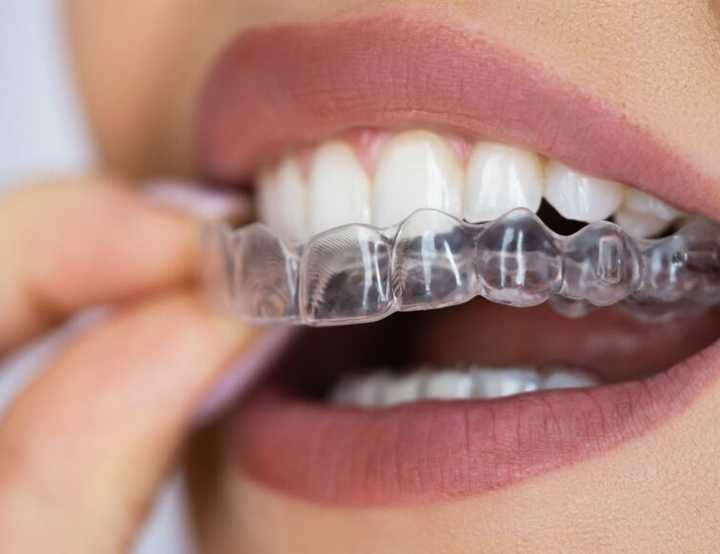Retainers being placed onto teeth